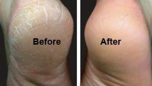 [HCM]kem trị nứt gót chân DUIT FOOT AND HEEL BALM PLUS 50gr