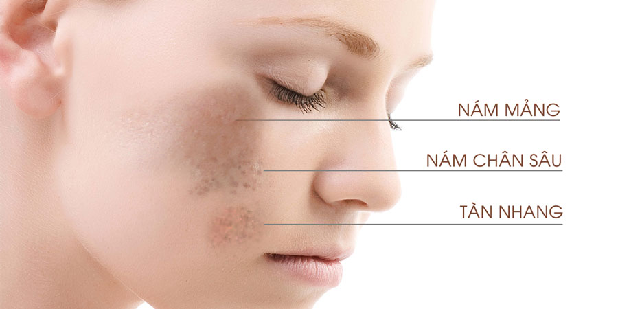 Serum nám sạm tàn nhang DELUXE LA