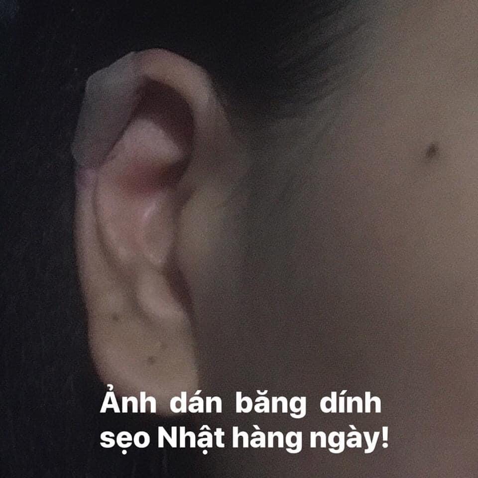 Băng dán sẹo lồi NICHIBAN (Nhật Bản)