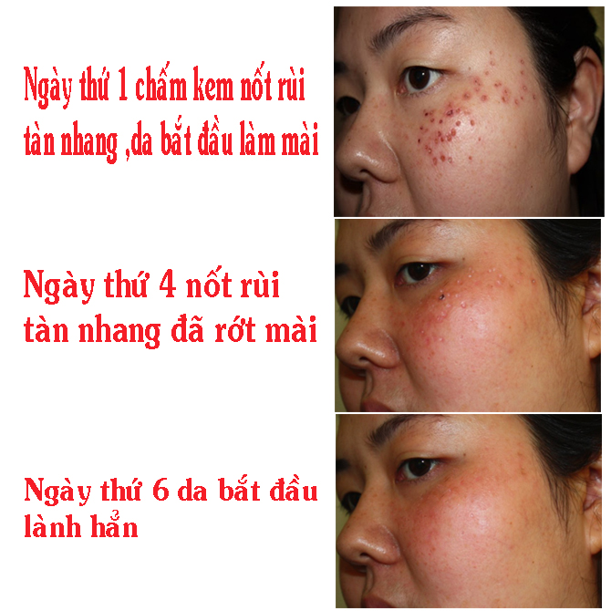 KEM TẨY MỤN CƠM, MỤN CÓC, NỐT RUỒI, MỤN THỊT, TÀN NHANG POPI