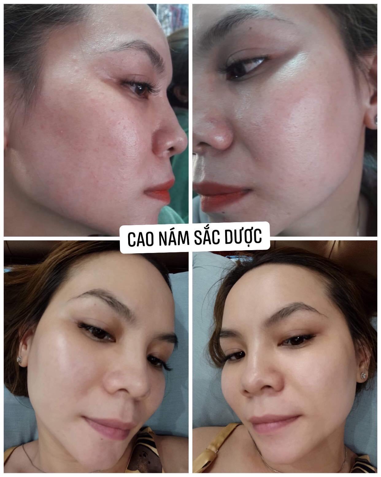 Kem Sắc Dược Ngừa Nám Sạm