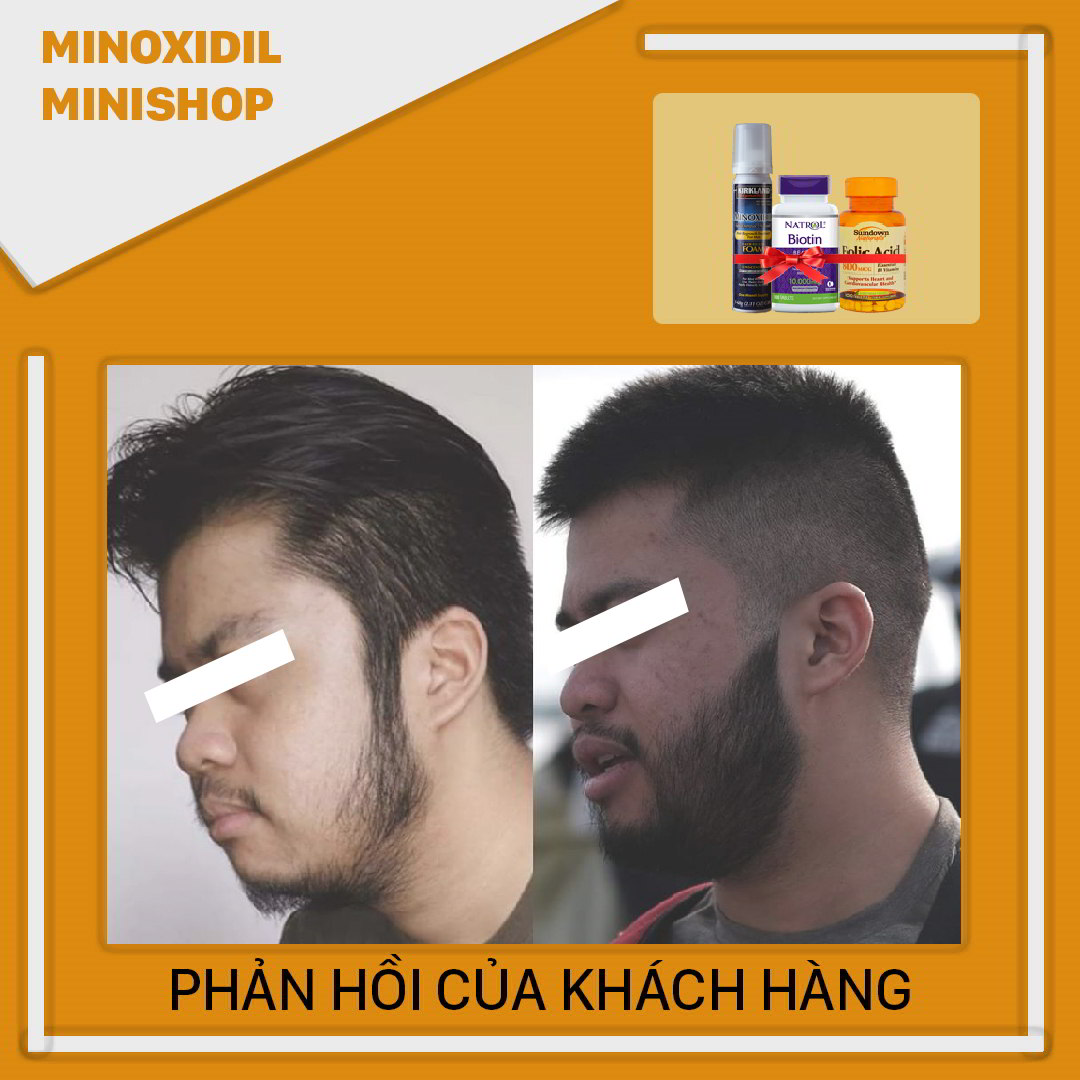 Minoxidil 5% Dạng Bọt Mọc Râu Tóc Combo Biotin Folic