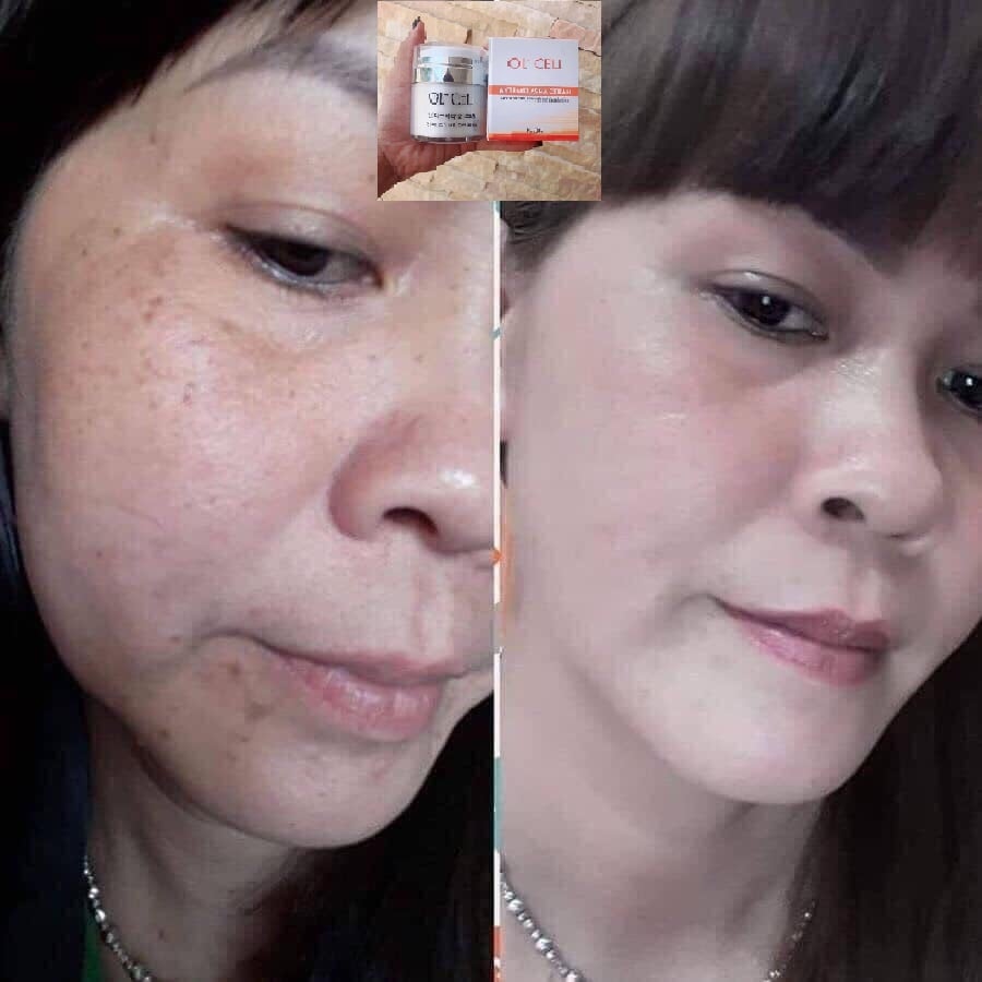 ( Mua 1 tặng 1) Olcell hút nám tặng kem trắng da mặt 22Again