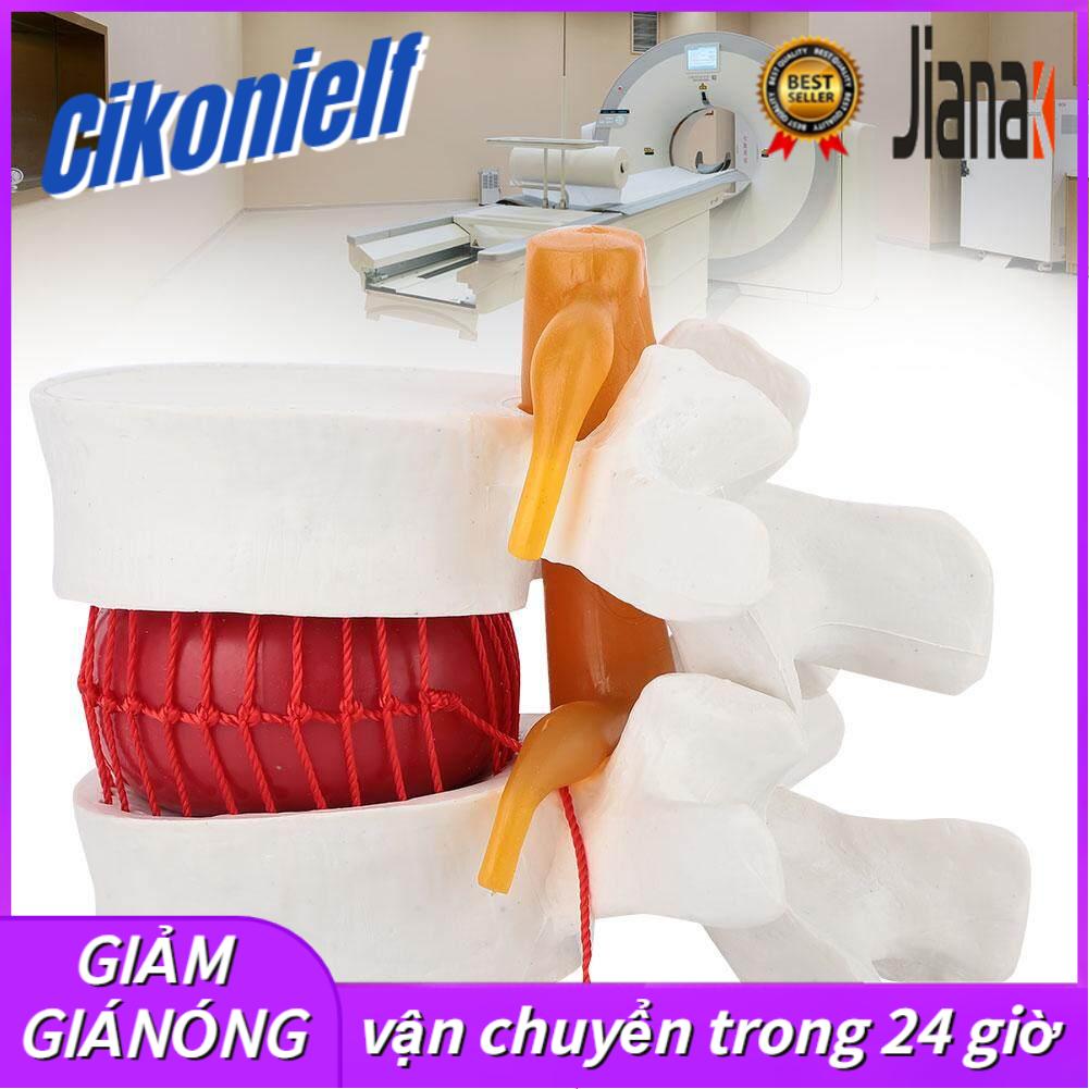 1:1.5 Medical Demonstration Model Of Lumbar Vertebral Spine Human Lumbar Disc Herniation Model