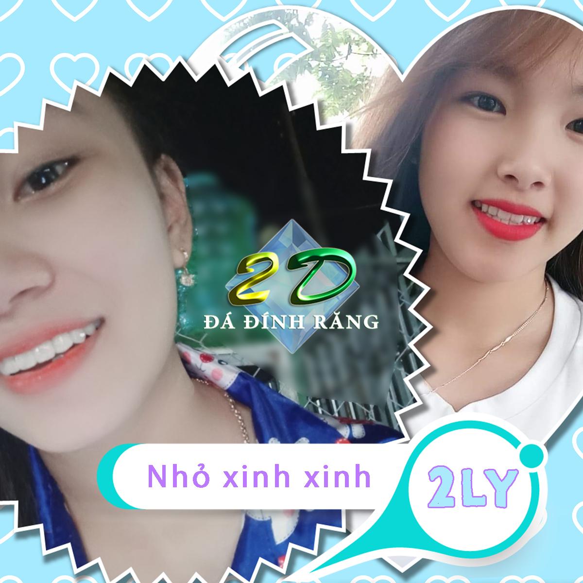 Mua 1 tặng 1 -Đá đính răng Thụy Sĩ 2LY (loại nhỏ xinh xinh)