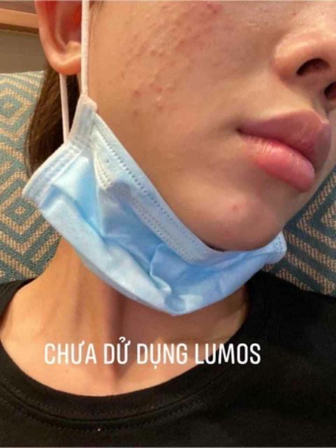 [MẪU MỚI] SERUM MỤN LUMOS ACNE 5ML- XÓA MỤN [CHÍNH HÃNG]
