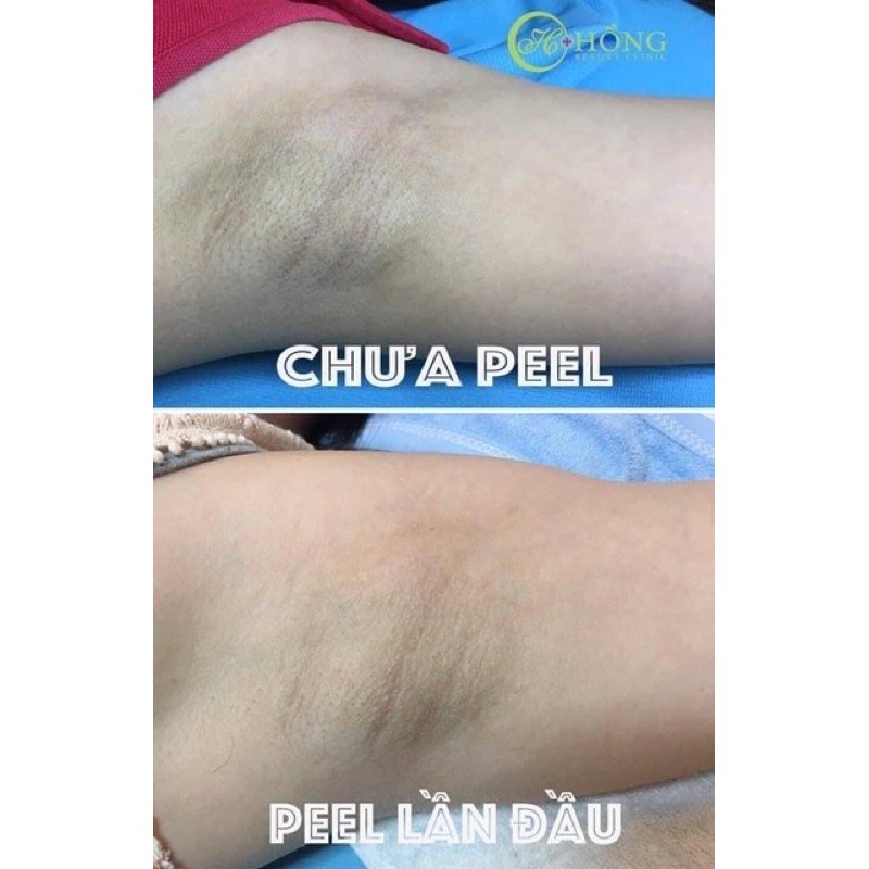 Peel hồng ti,nách, bikini TCA USA