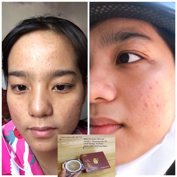 [HCM]Cao Mụn Sâm Đỏ (15g/hộp) Chính Hãng Meea Oranic