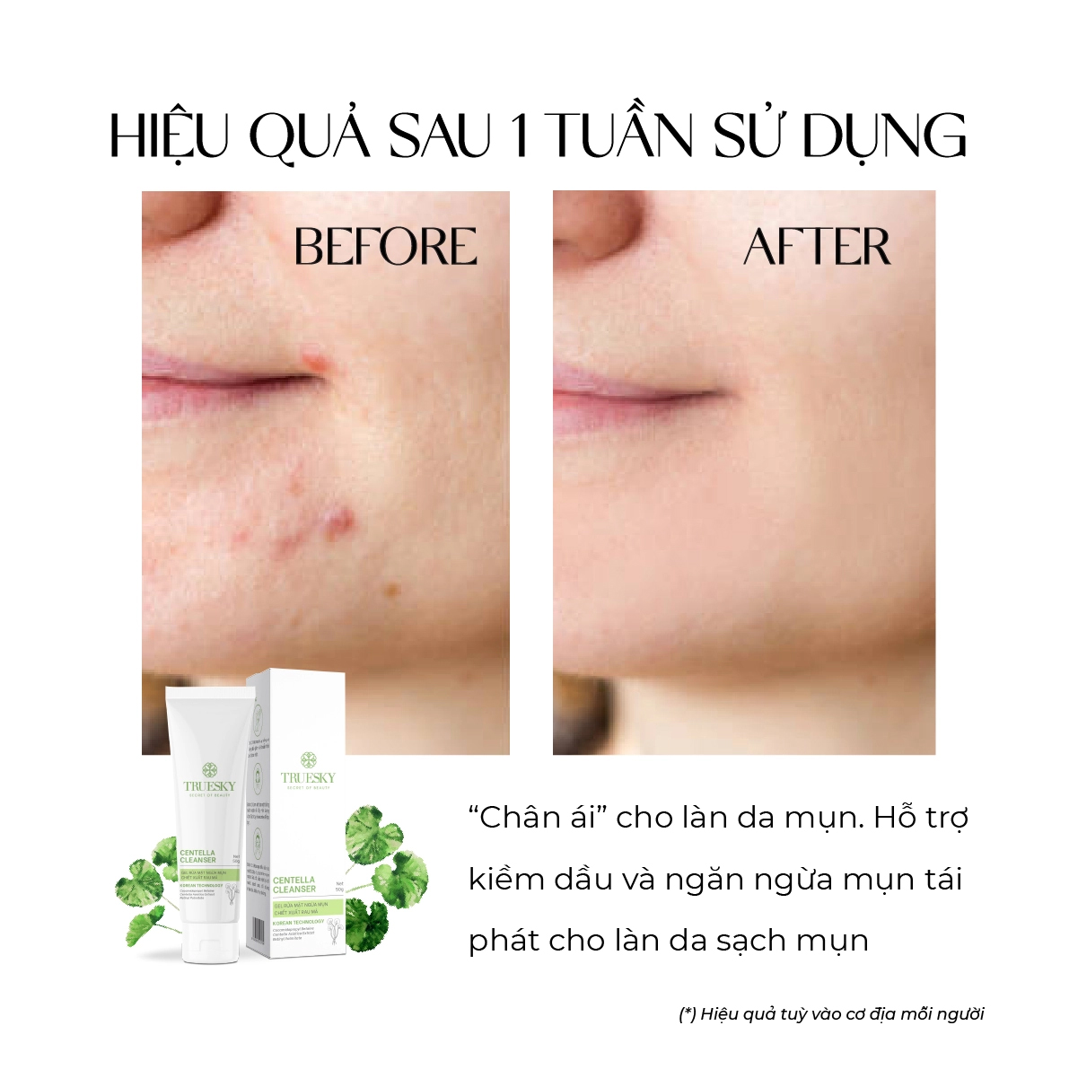 Sữa rửa mặt ngừa mụn cho da dầu Truesky Centella Cleanser 50g chiết xuất rau má