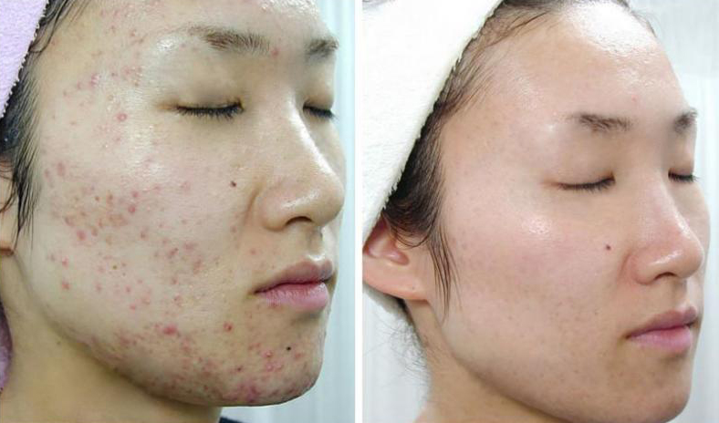 Serum tri Mụn Bọc tận gốc  Doctor Care