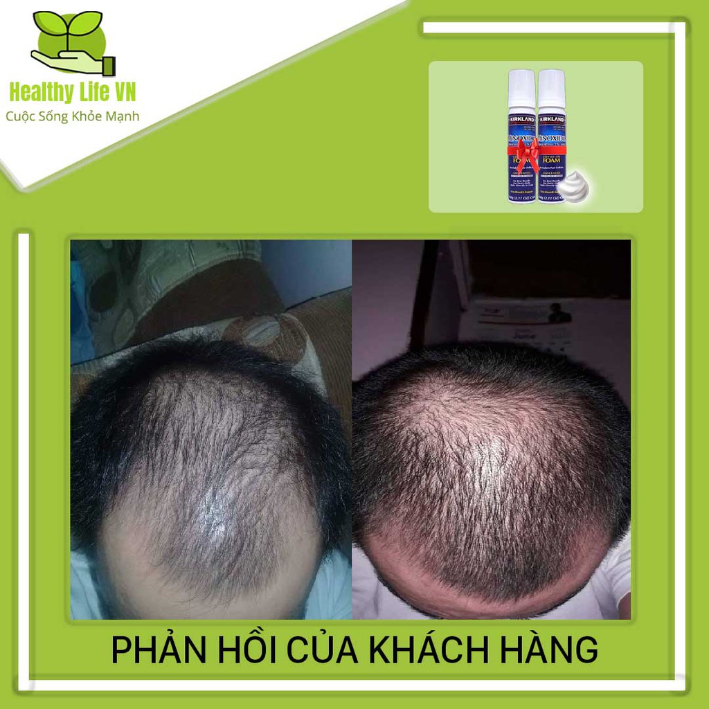 Minoxidil 5% Dạng Bọt Mọc Râu Tóc Kirkland Mỹ Combo 2 Lọ