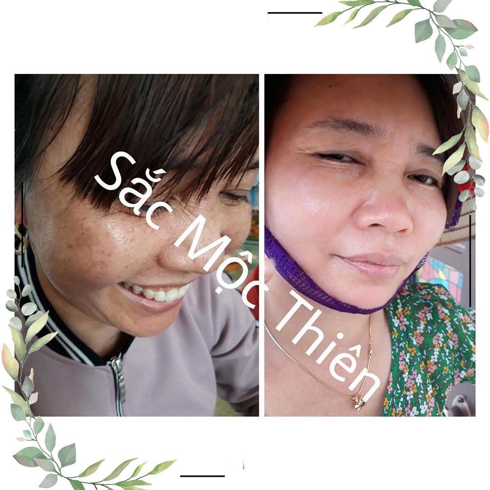 [HCM]Tái Tạo Da Sắc Mộc Thiên