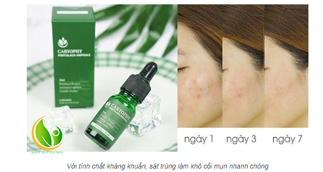 Serum Ngừa Mụn Thâm Dành Cho Da Nhờn Caryophy [KÈM VIDEO]