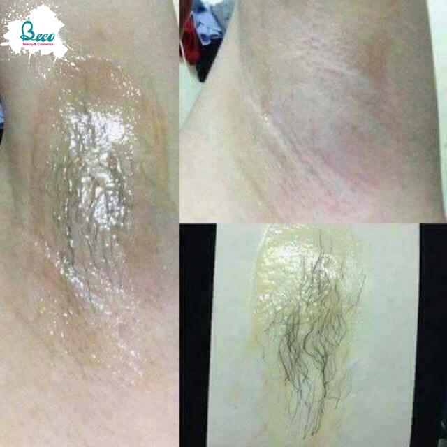 Wax Lông Veo Ngân Bình Triệt Lông Vĩnh Viễn