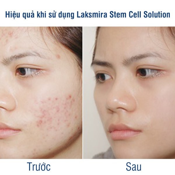 TẾ BÀO GỐC DƯỠNG TRẮNG LAKSMIRA STEM CELL SOLUTION - Tách Lẻ (1 lọ)