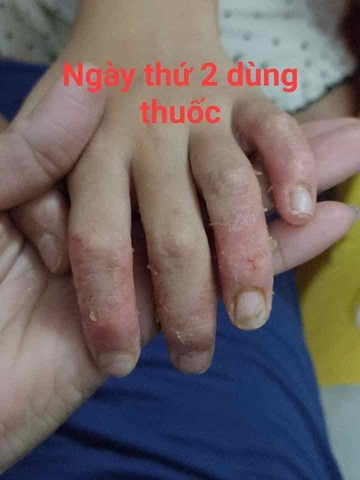 VIÊM DA TRẦN KIM HUYỀN
