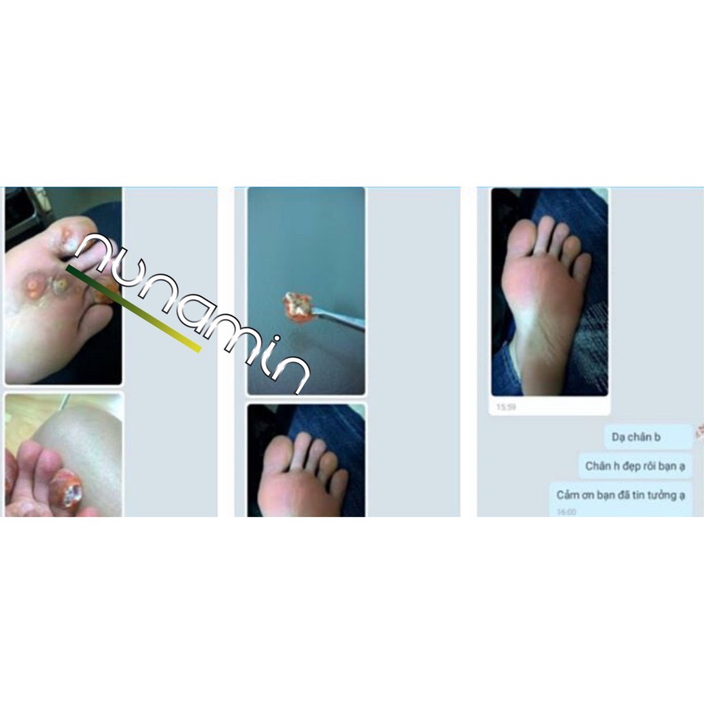 Nunamin warts & corns - Hỗ trợ giảm mụn cóc, mụn cơm