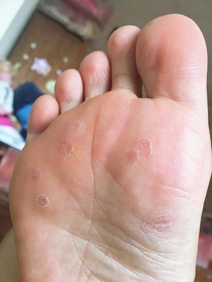 Mụn cóc Mụn cơm Mắt cá Chân Tay