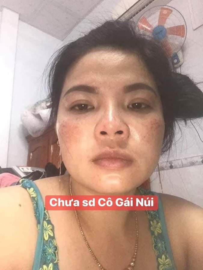Mặt nạ nám cô gái núi