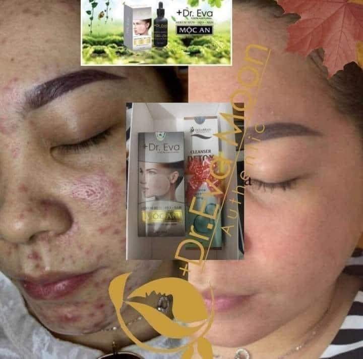 Cao sẹo collagen Dr Eva Chính Hãng