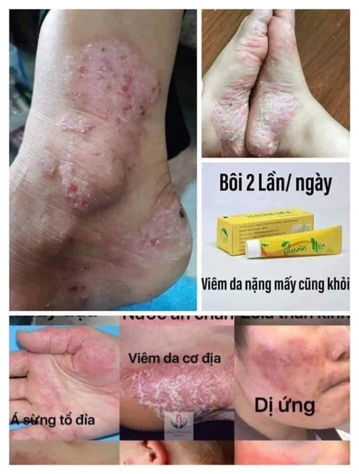 KEM BÔI DA THUẦN MỘC (MẪU MỚI)