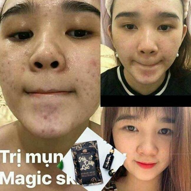 TINH CHÂT NGỪA MỤN ĐÔNG Y MAGIC SKIN
