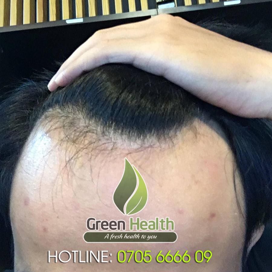 (Tặng Peo) 1 lọ Morr F5% Minoxidil hỗ trợ mọc tóc, giảm rụng tóc