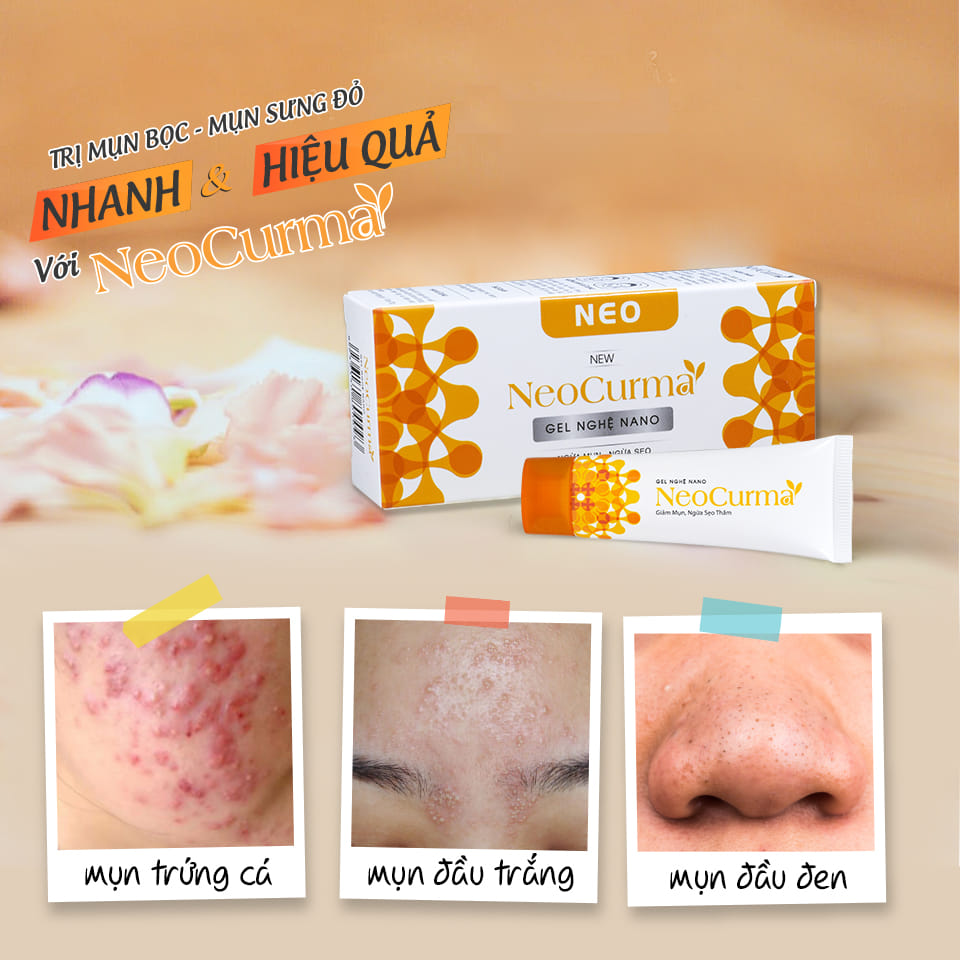GEL NGHỆ NEOCURMA – NGĂN MỤN, MỜ THÂM SẸO (20G)