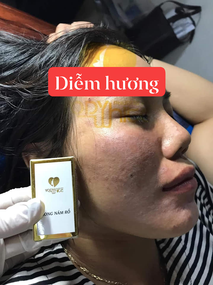 Bong nám rỗ Yody White Phương Anh