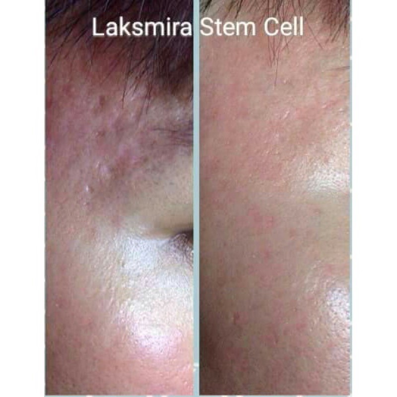 [HCM][Chính Hãng] Tế Bào Gốc RHA LAKSMIRA STEM CELL SOLUTION