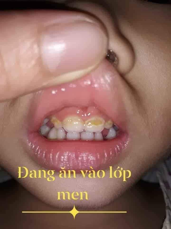 Sâu răng Nhật Dương