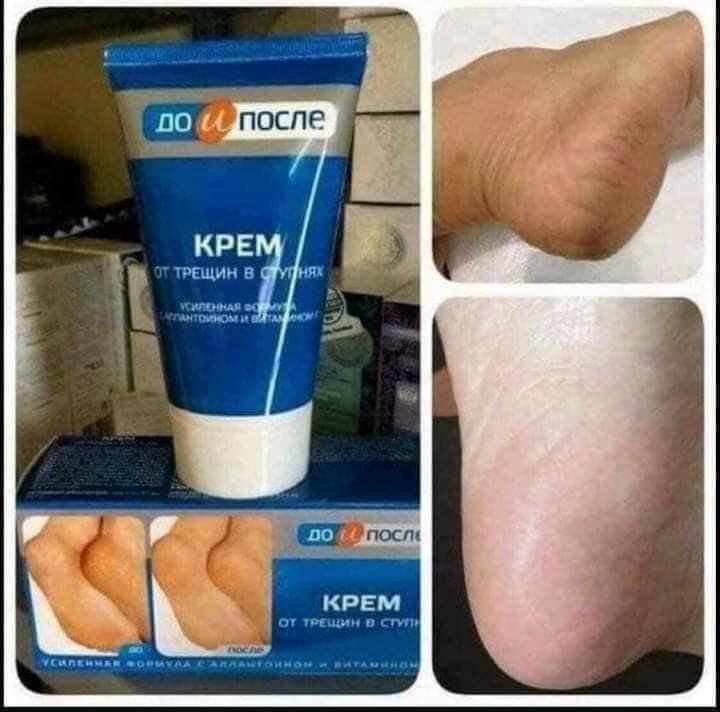 KEM BÔI NỨT GÓT CHÂN KPEM
