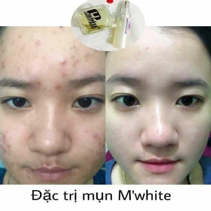 Kem trị mụn Mwhite tặng quà
