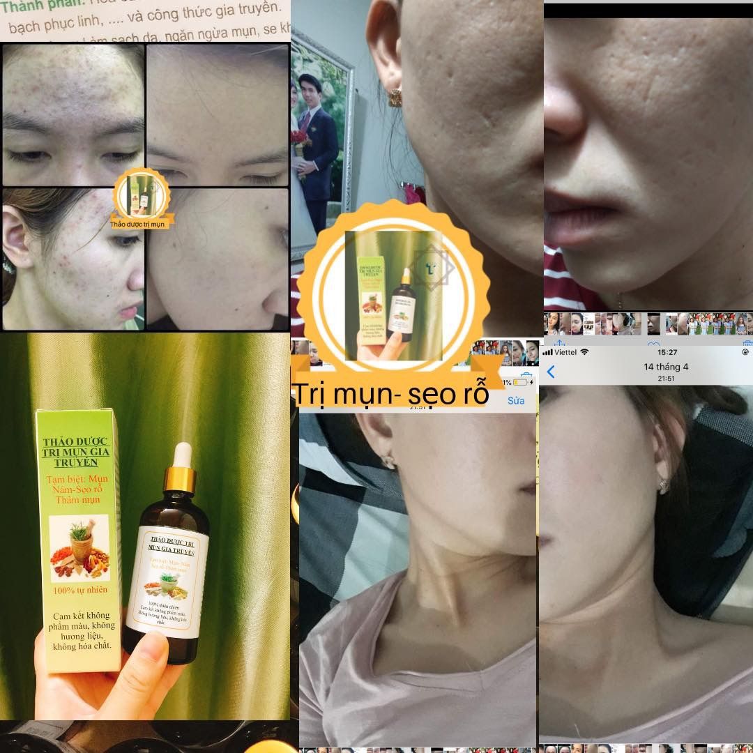 COMBO TÁI TẠO DA ( Tạm biệt mụn )