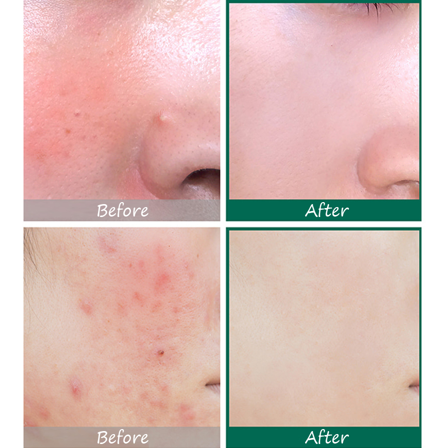 Bộ Kit 4 món Some By Mi AHA - BHA - PHA 30 Days Miracle Ac Sos Kit