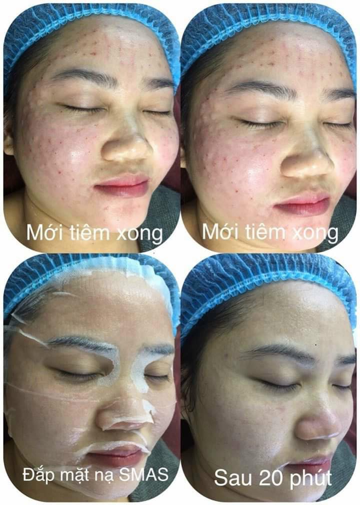 Mặt Nạ Dưỡng Và Phục Hồi Da SMAS Peptide Silk Mask