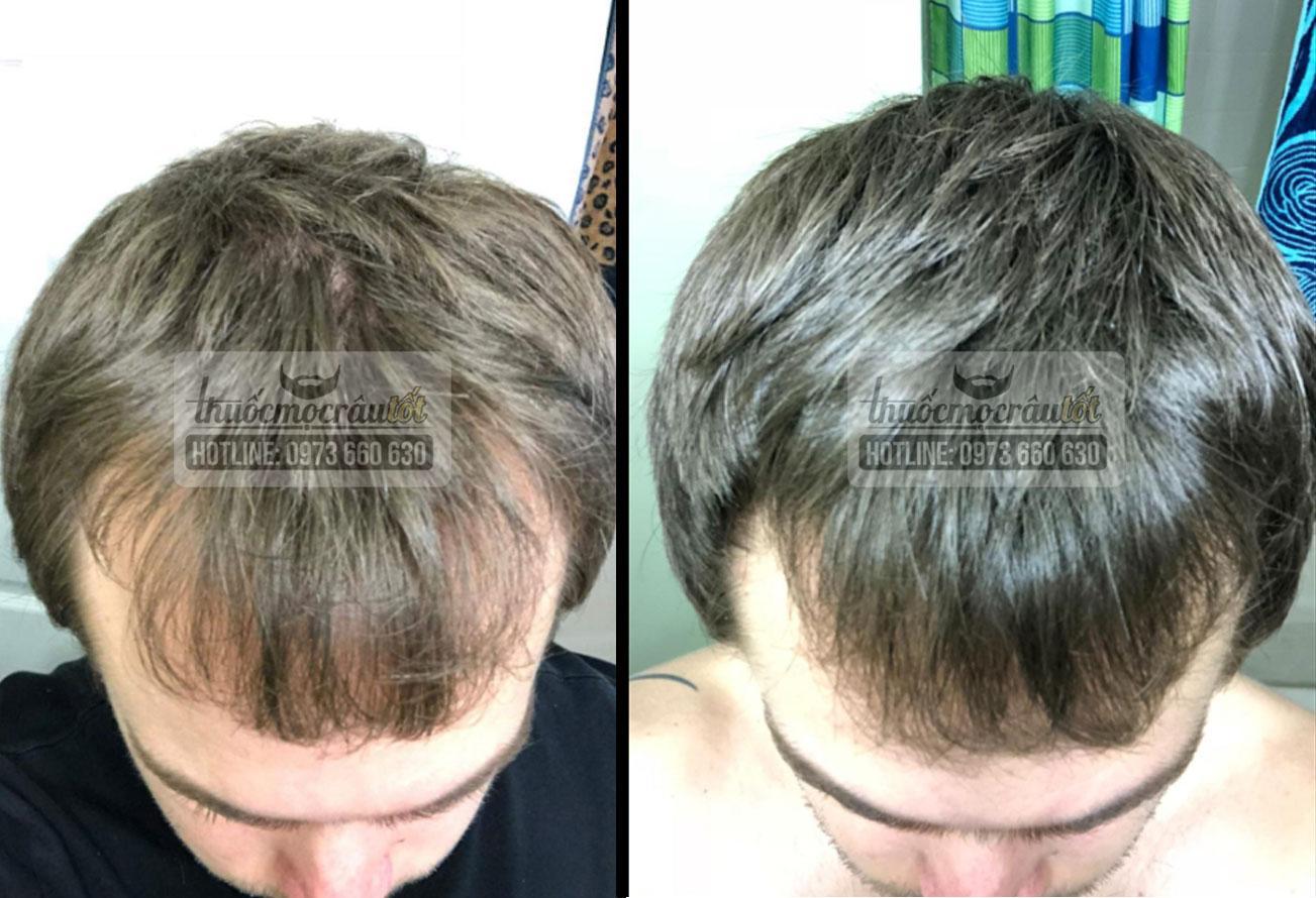 [HCM]Thuốc mọc tóc Mỹ hãng Kirkland