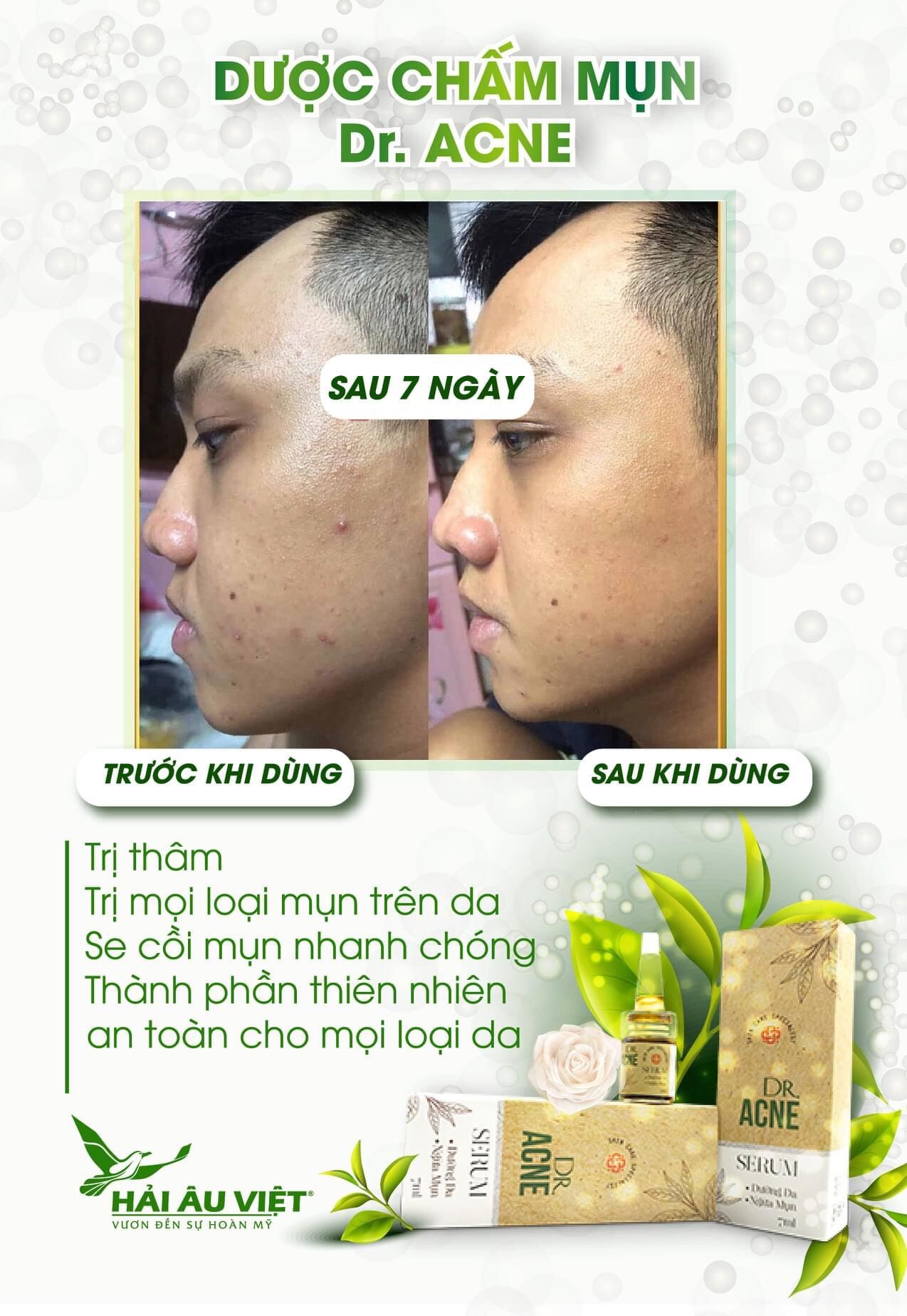 Chấm mụn 2 lớp xẹp mụn sau 4h