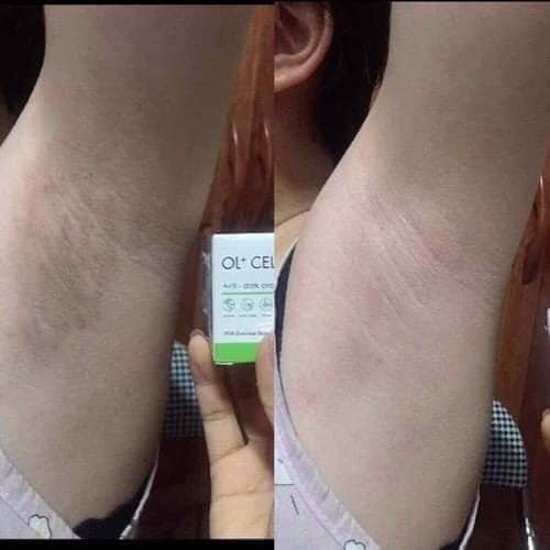 [HCM]Kem trị thâm nách thâm môi thâm đầu gối OL-CELL