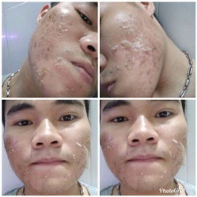 Lột BEZY Tái Tạo Da Mặt Hết Nám Thâm Sạm