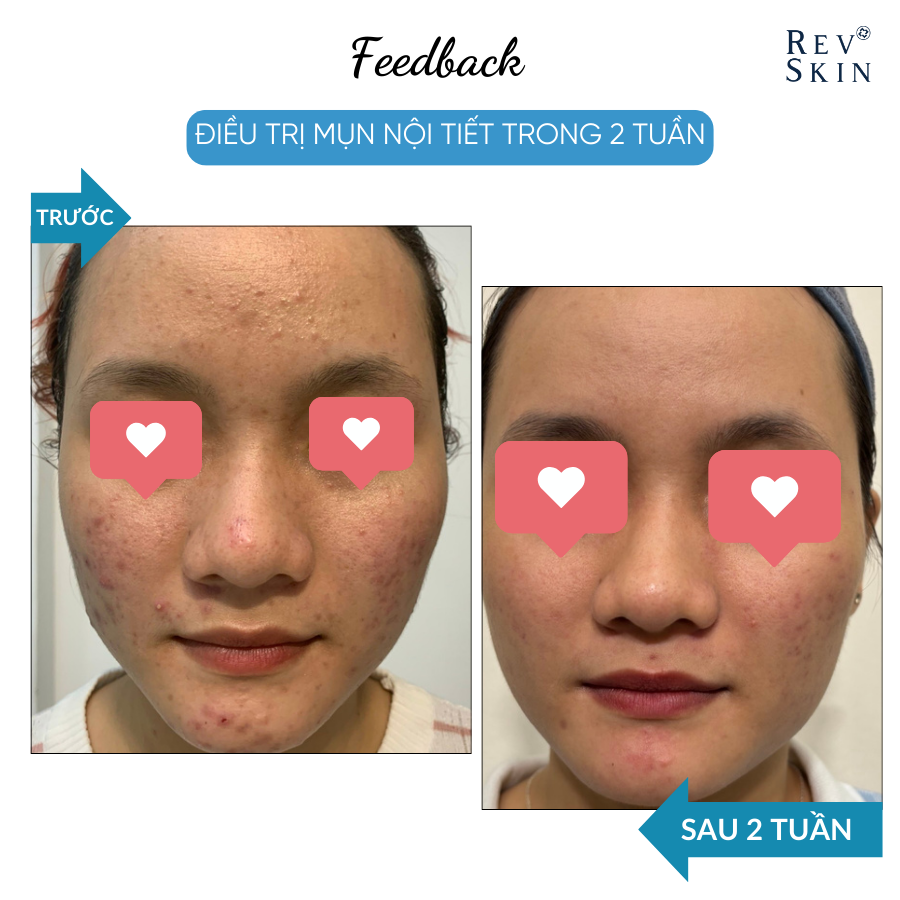 Sữa Rửa Mặt RevSkin Deep Cleanser Cho Da Dầu - Mụn - 60g