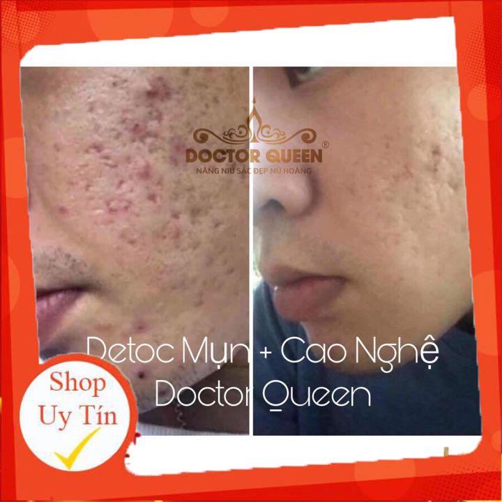 Serum Detox Mụn Doctor Queen 🔥𝐍𝐄𝐖🔥 (Ngừa Tất Cả Các Loại Mụn,Thâm,Đào Thải Phục Hồi Tái Tạo Da,Da Yếu, Giãn Mao Mạch)