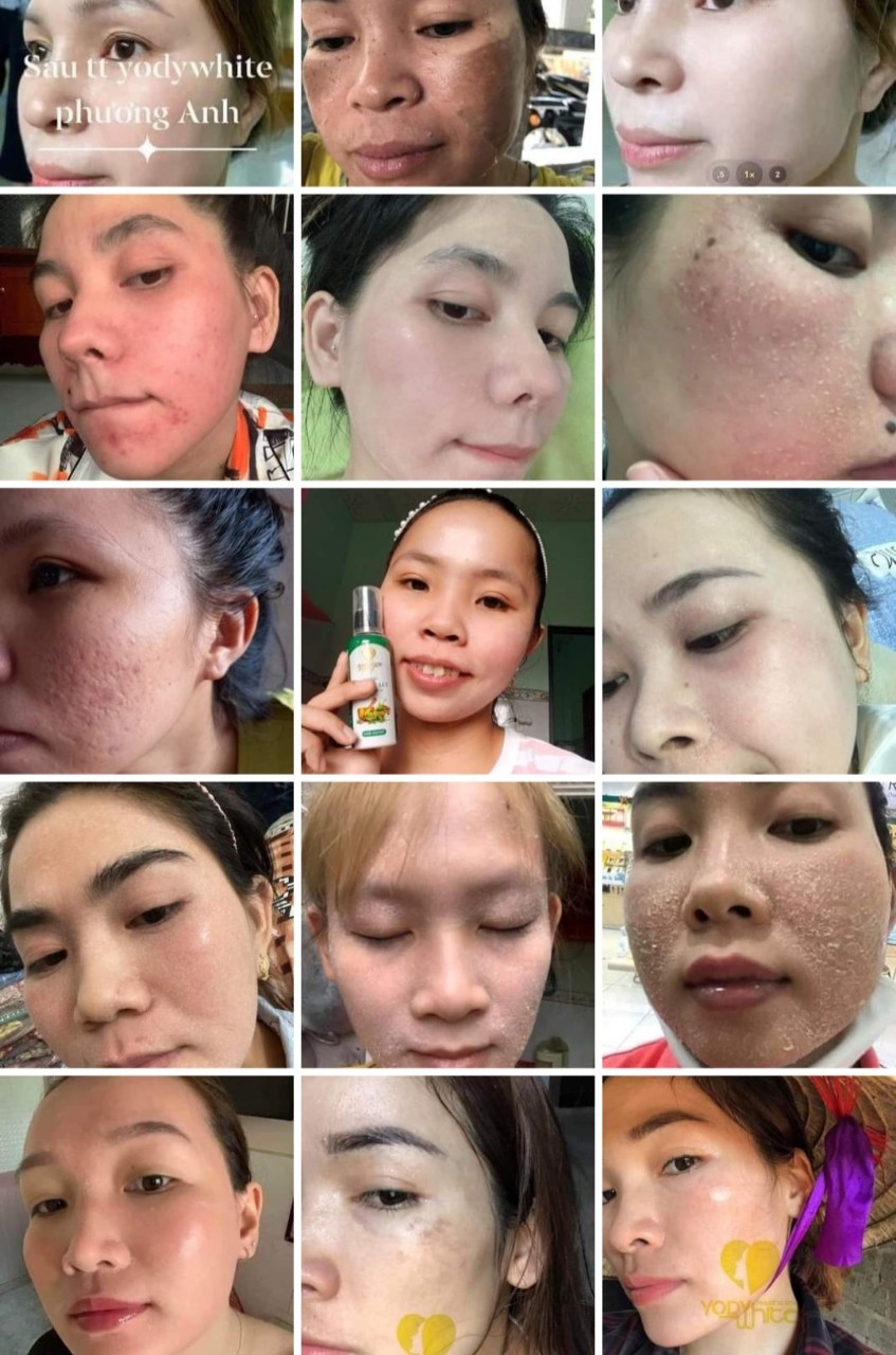Combo 2 Chai Tái Tạo Da Phương Anh Yody White
