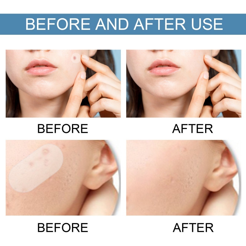 80Pcs Pimple Patch Makeup Invisible Hydrocolloid Comedo Patches