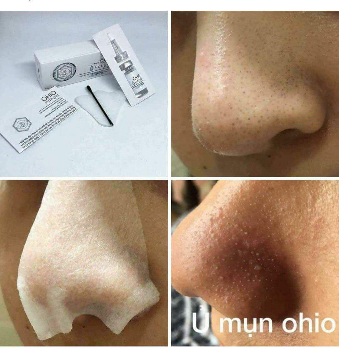 serum Ủ mụn đầu đen Ohio - đánh bay mụn đầu đen