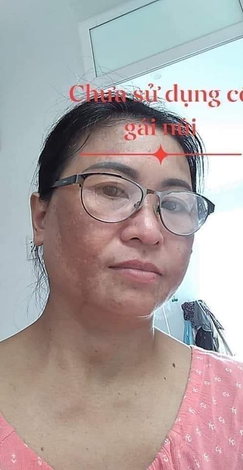 [HCM]Cỏ tr ị nám Cô Gái Núi