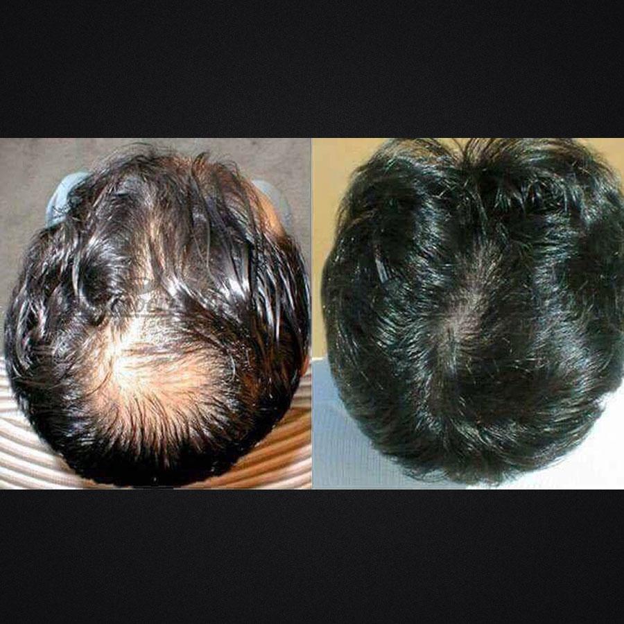 [HCM]Thuốc mọc tóc Mỹ hãng Kirkland