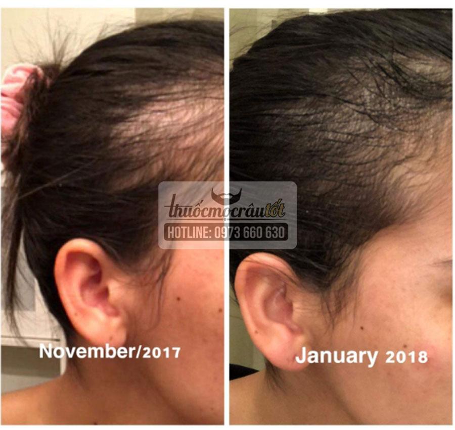 [HCM]Thuốc mọc tóc Mỹ hãng Kirkland