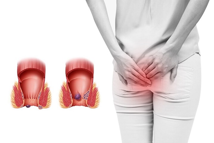 [Đặt là tịt trĩ , co búi trĩ ][Hàng hot của Đức] Viên đặt Trĩ Hametum Hamorrhoidensalbe 10 viên của Đức