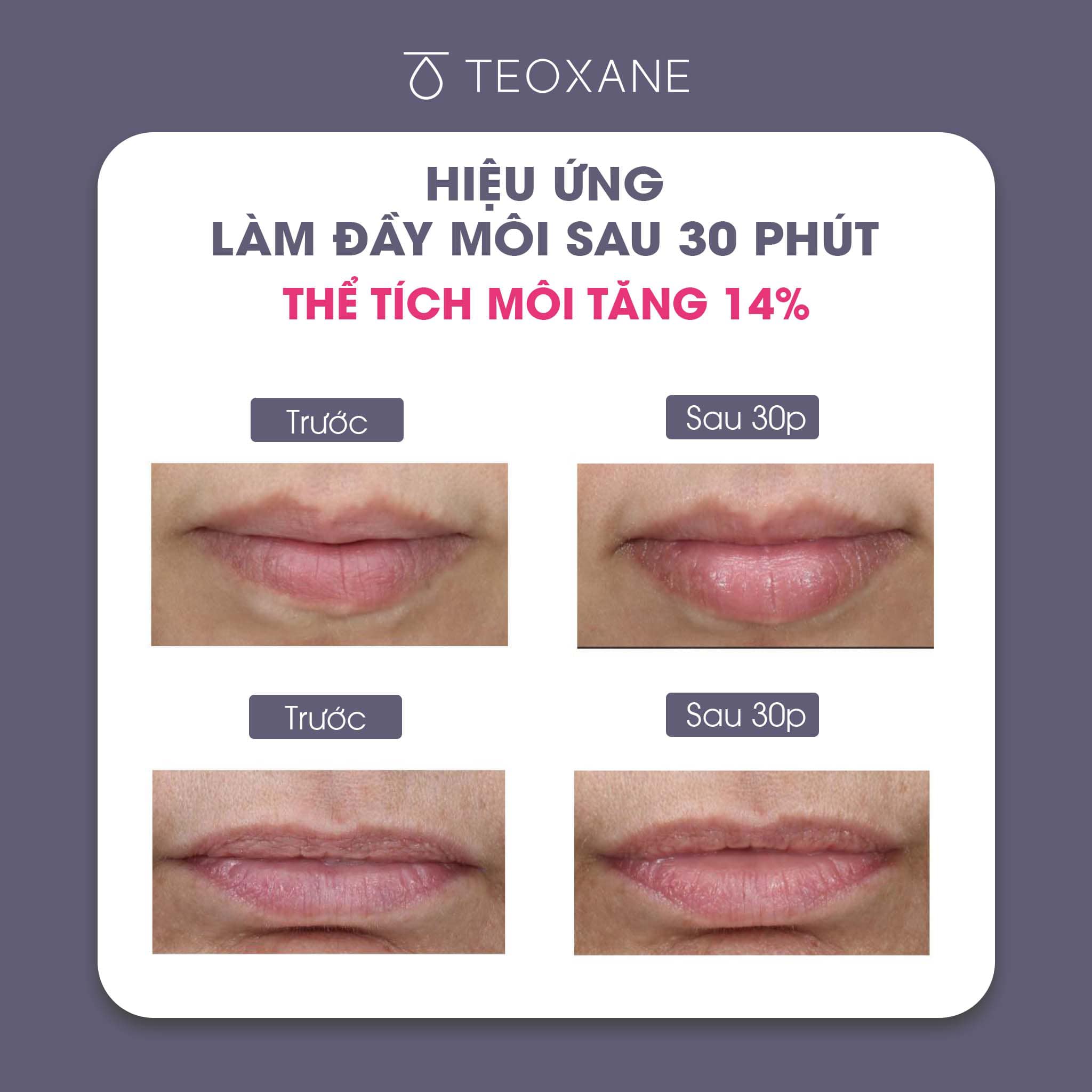 Son dưỡng làm căng đầy môi Teoxane 3D LIP (10ml)